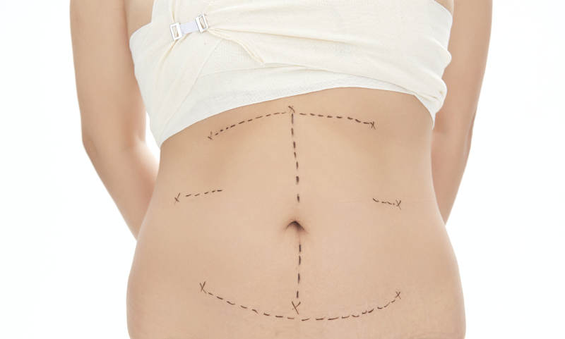 医学美容身体整形手术前躯干上的蚂蚁线图片