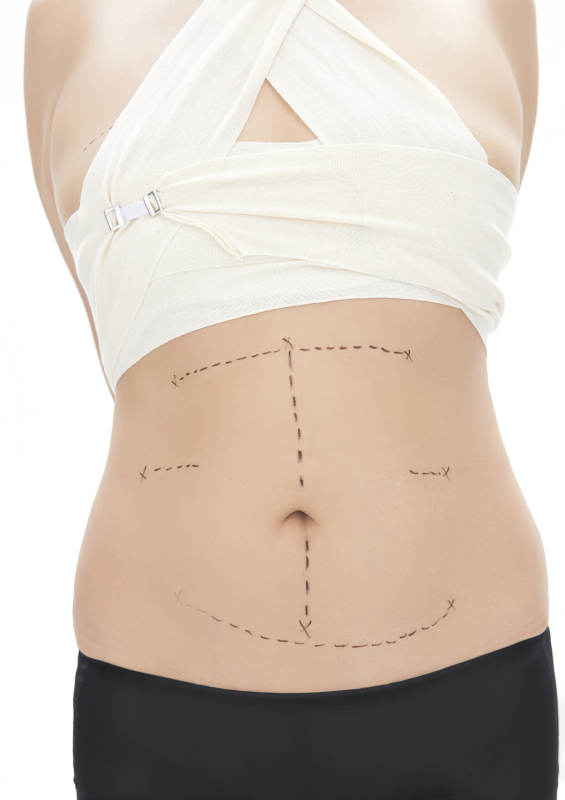 医学美容身体整形手术前躯干上的蚂蚁线图片