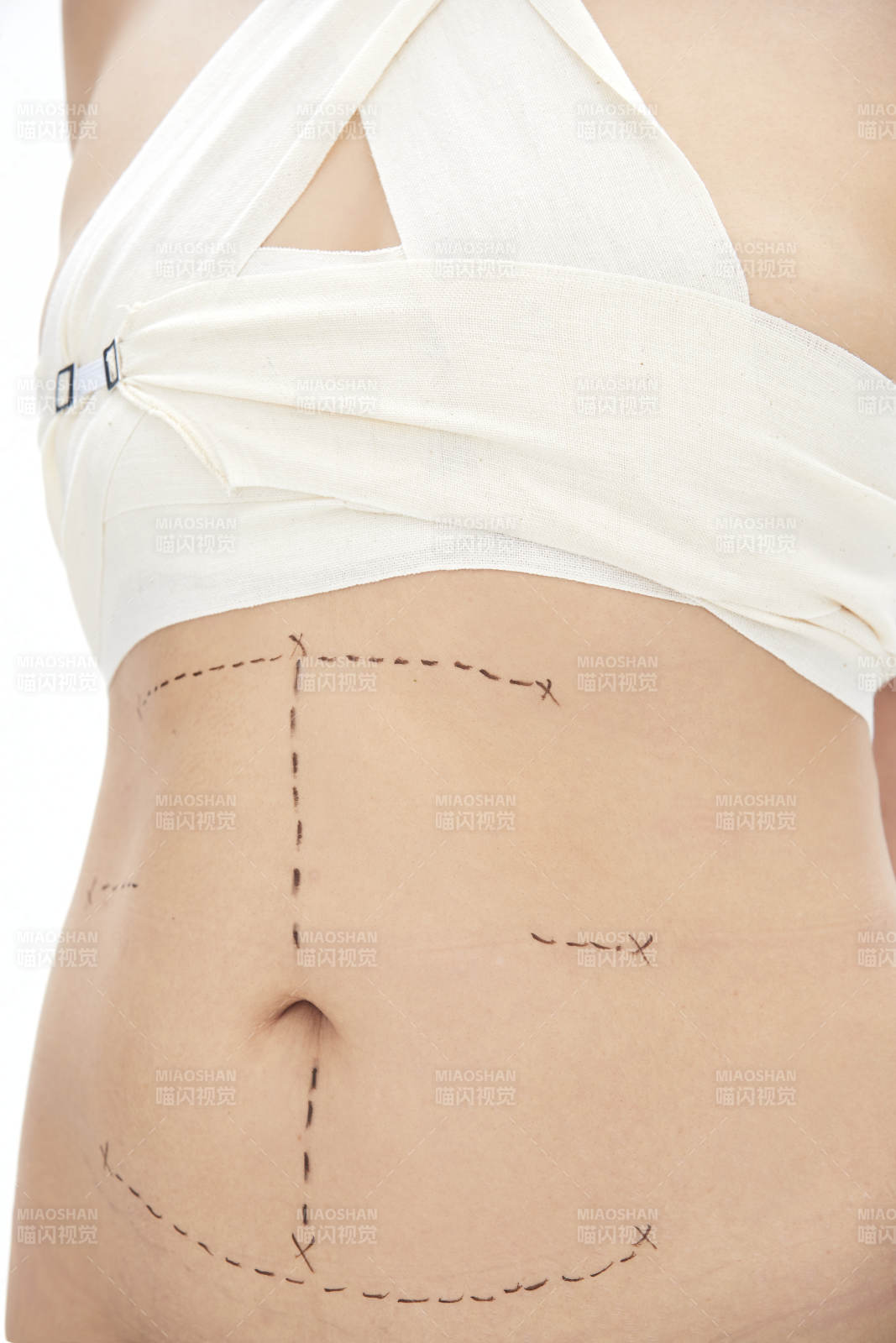 医学美容身体整形手术前躯干上的蚂蚁线图片