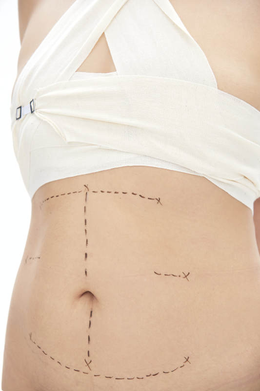 医学美容身体整形手术前躯干上的蚂蚁线图片