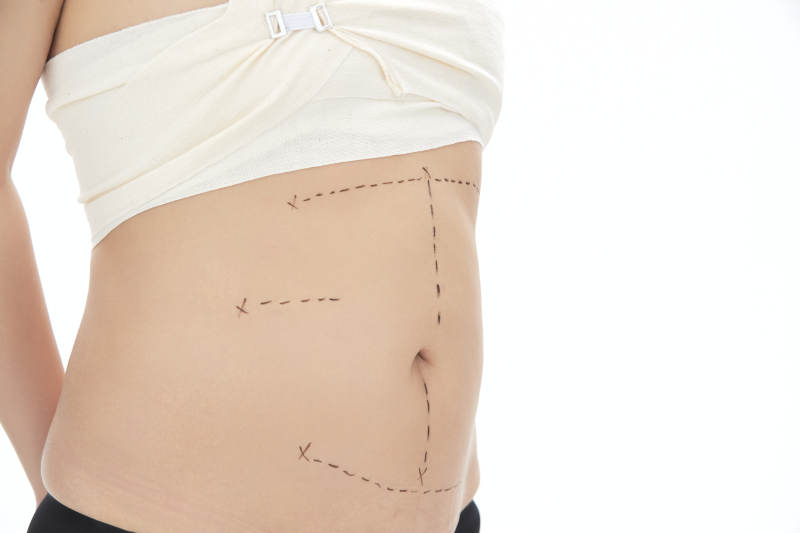 医学美容身体整形手术前躯干上的蚂蚁线图片