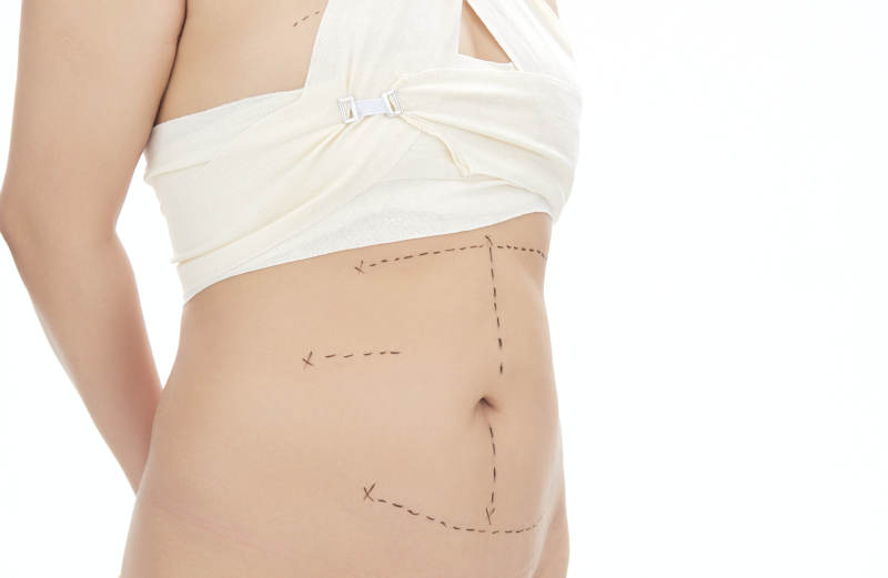 医学美容身体整形手术前躯干上的蚂蚁线图片