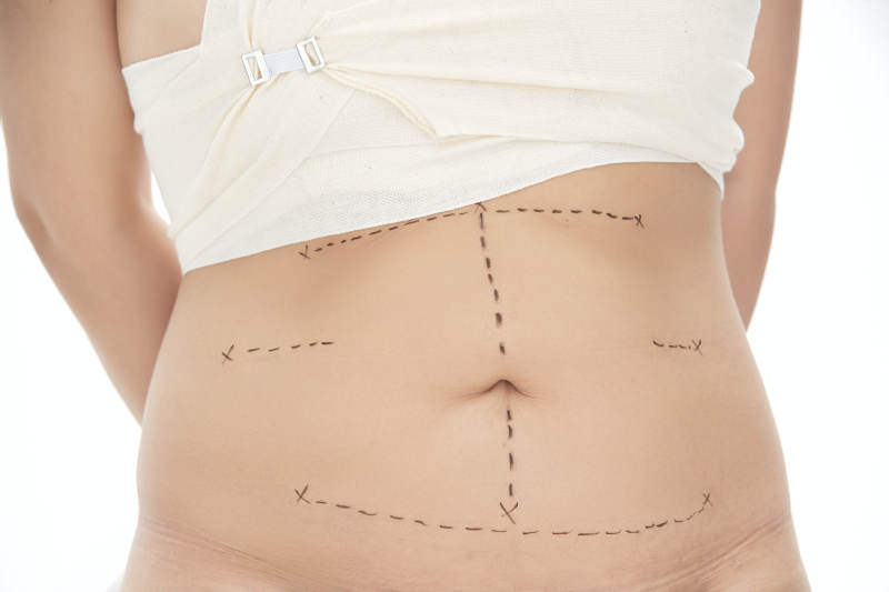 医学美容身体整形手术前躯干上的蚂蚁线图片