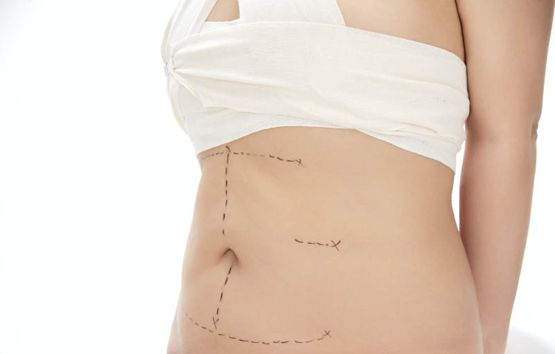 医学美容身体整形手术前躯干上的蚂蚁线图片