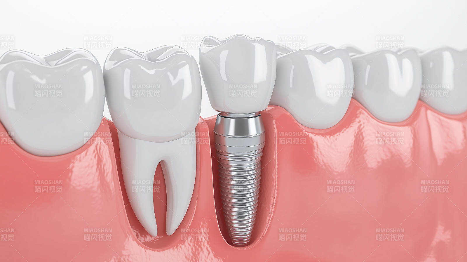 牙科种植体示意图图片