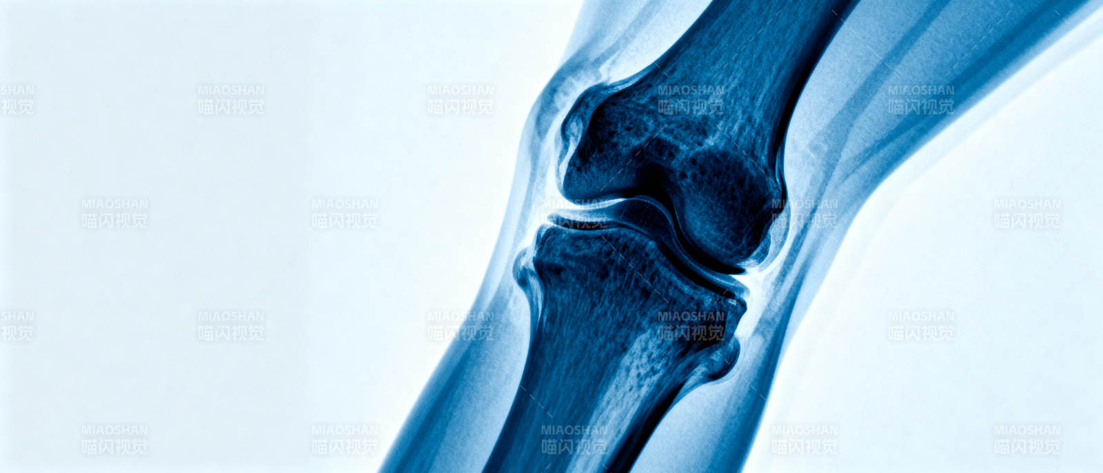 膝关节X光影像图片