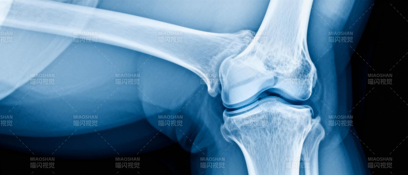膝关节X光影像图片