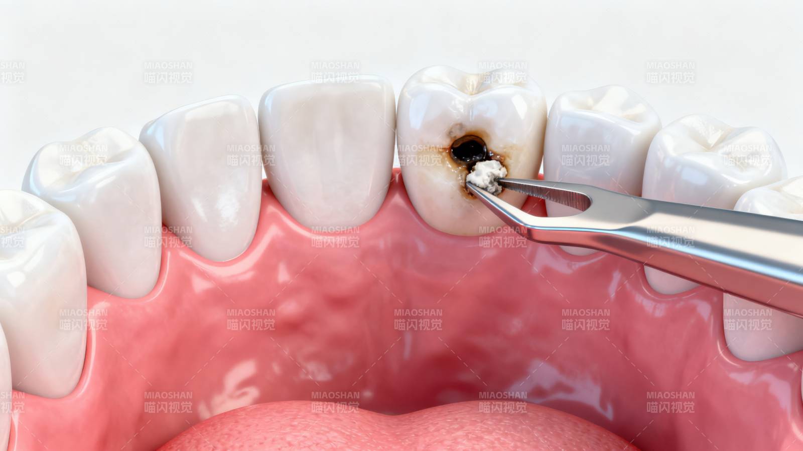 牙齿龋齿补牙治疗过程图片