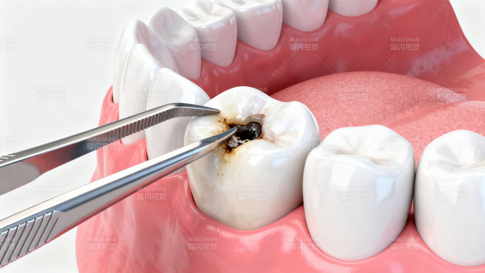 牙齿龋齿治疗过程展示图片