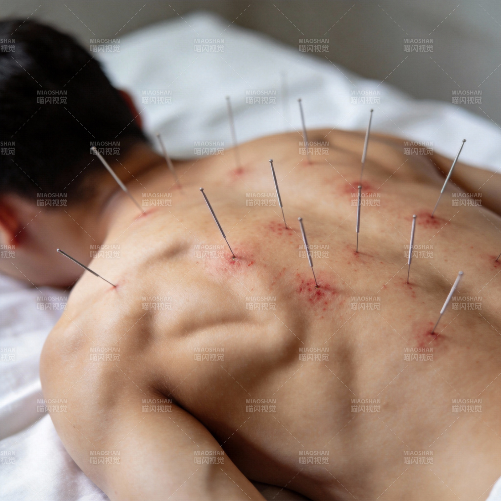 针灸治疗背部图片