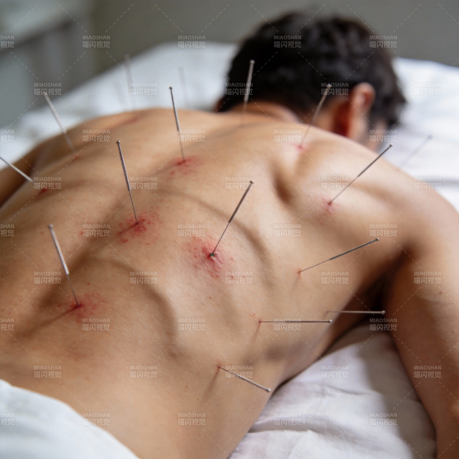 针灸治疗背部穴位图片