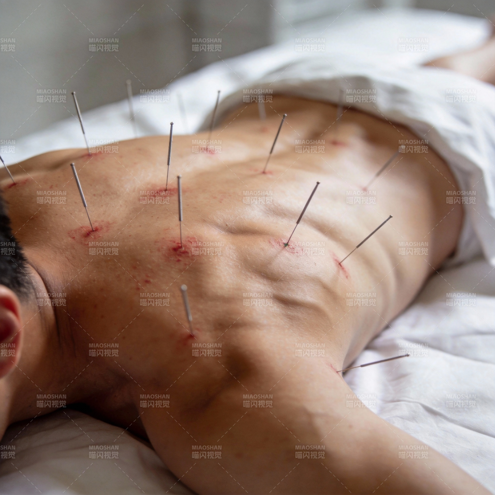 针灸治疗背部图片