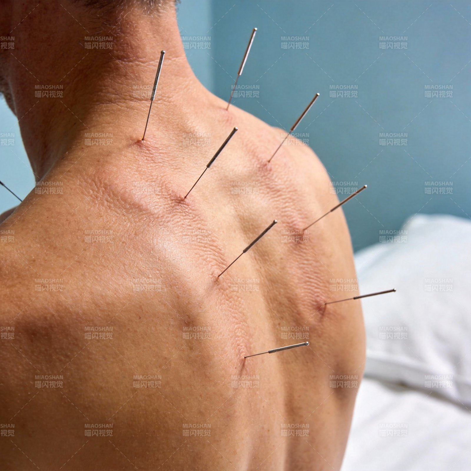针灸治疗背部图片