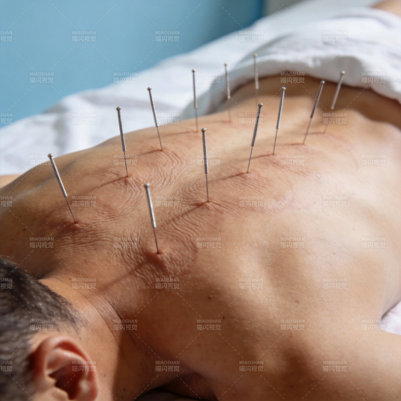 针灸治疗背部图片