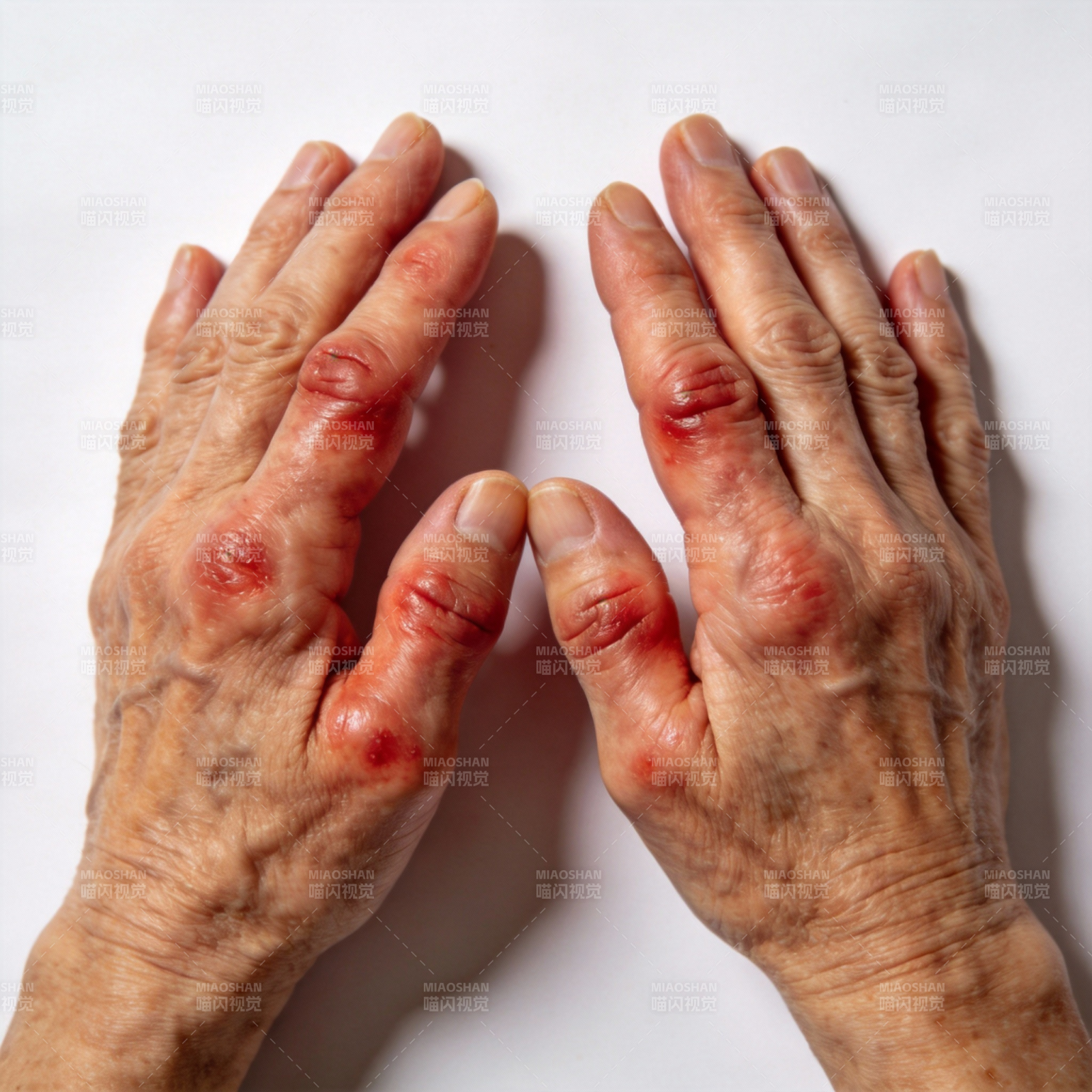 关节炎手部症状图片