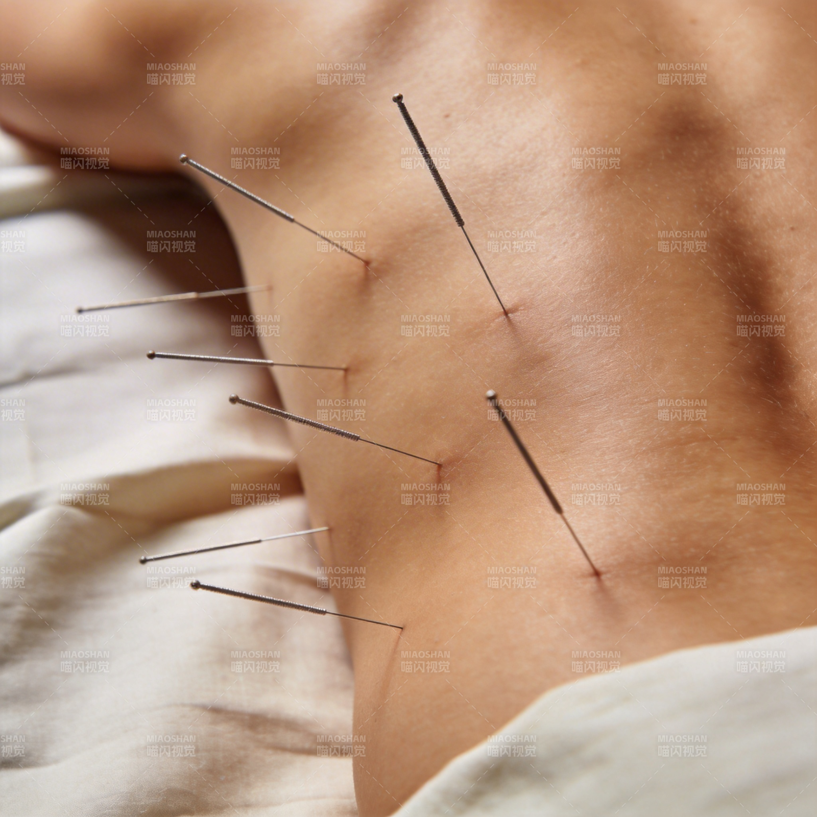 针灸治疗背部图片