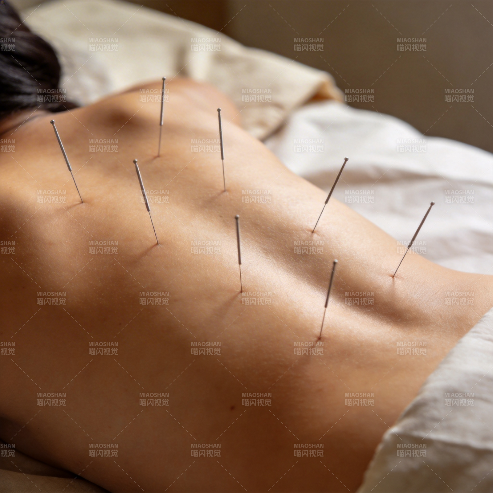 针灸治疗背部图片