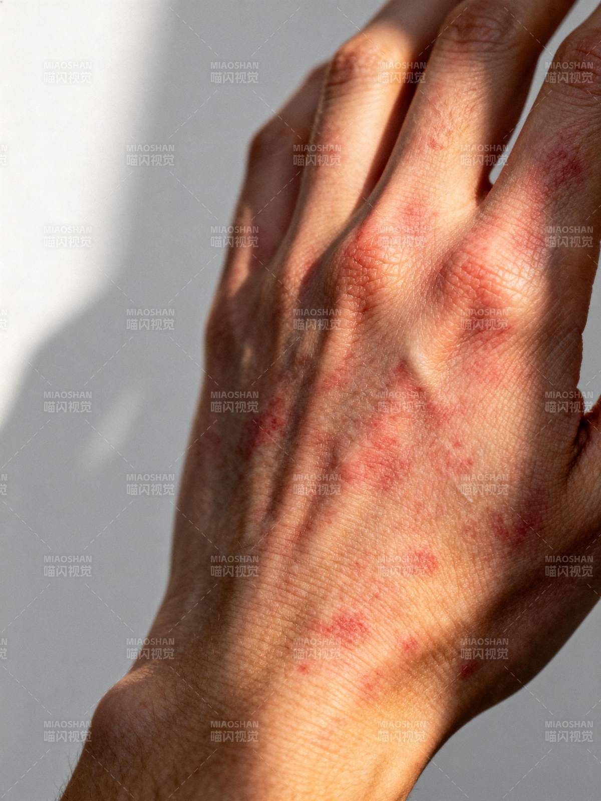 手背红疹特写图片