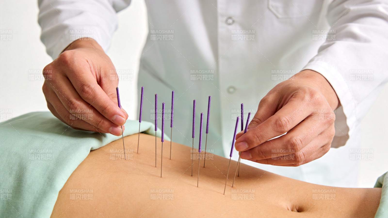 医生为患者腹部施针进行针灸治疗图片