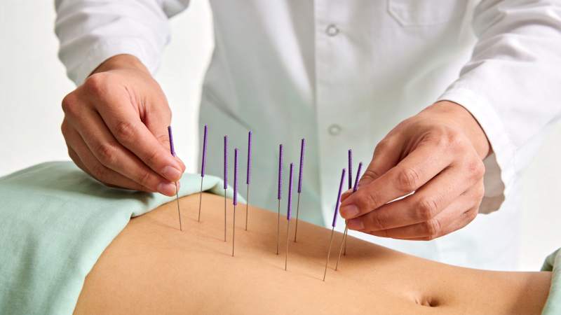 医生为患者腹部施针进行针灸治疗图片