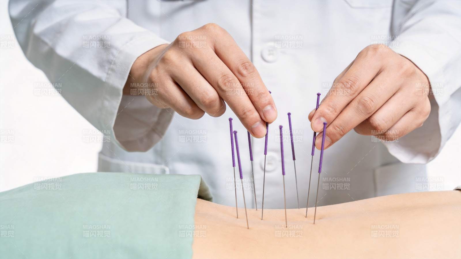 医生双手持针进行针灸治疗操作过程图片