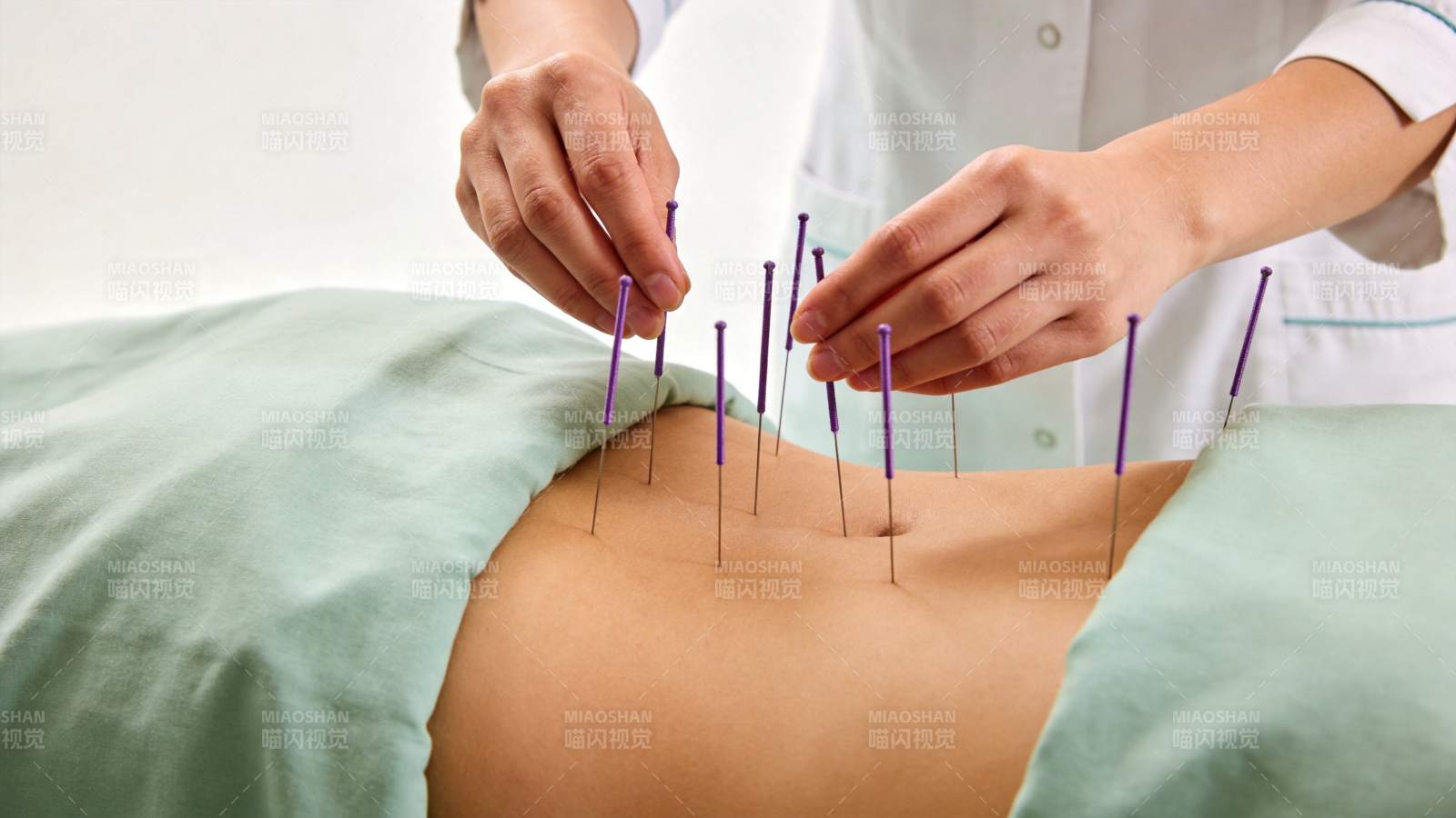 医生为患者腹部施针进行针灸治疗图片