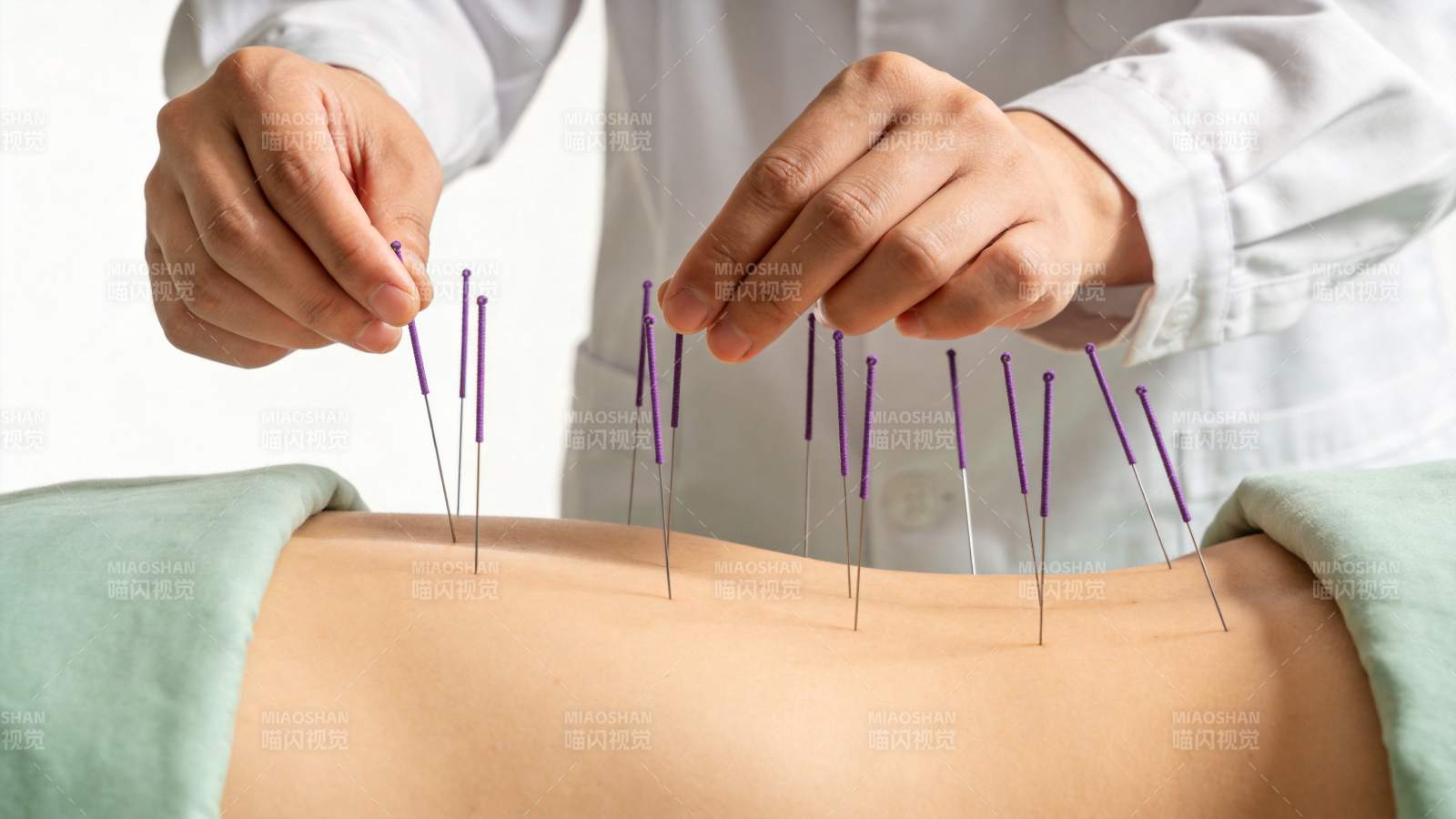 医生为患者背部施针进行针灸治疗图片