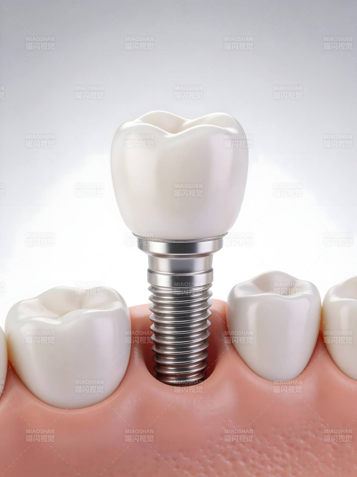 牙科种植体模型图片