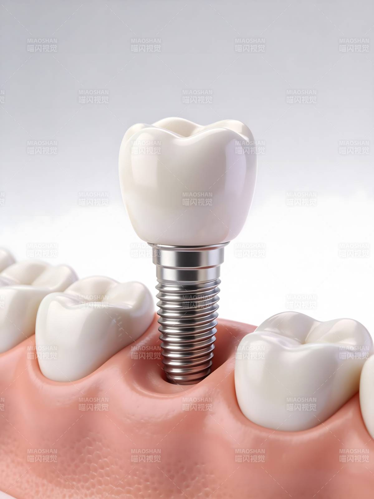 牙科种植体模型图片