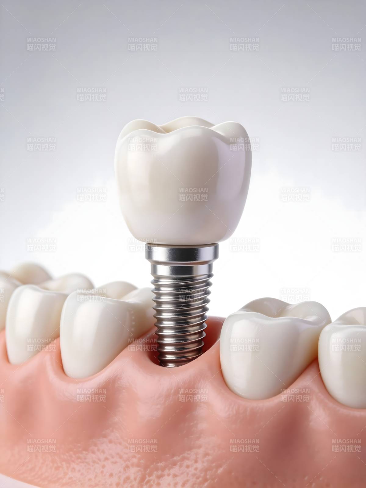 牙科种植体模型图片