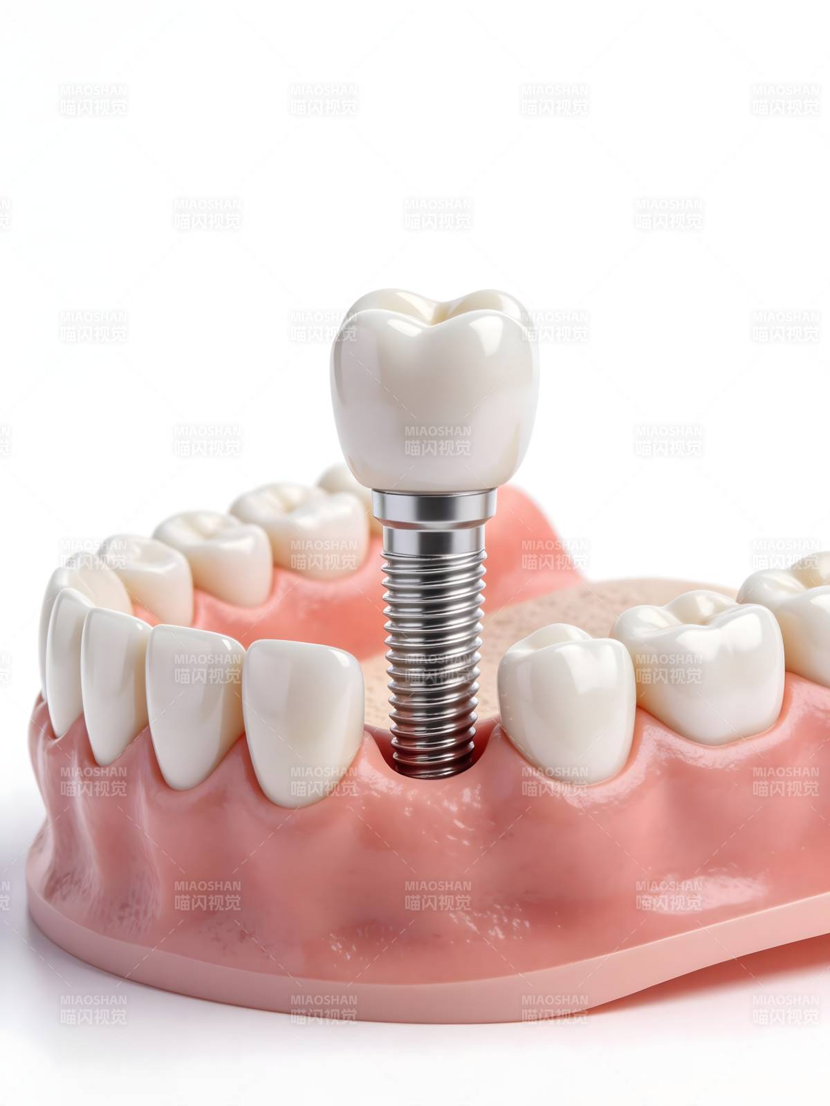 牙科种植体模型图片