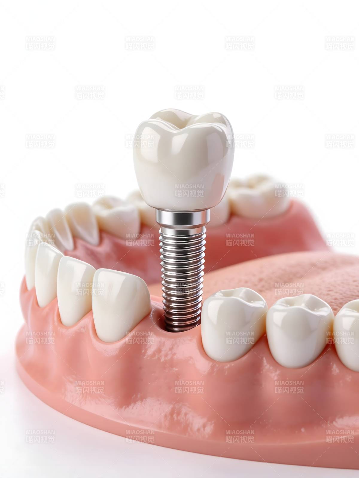 牙科种植体模型图片