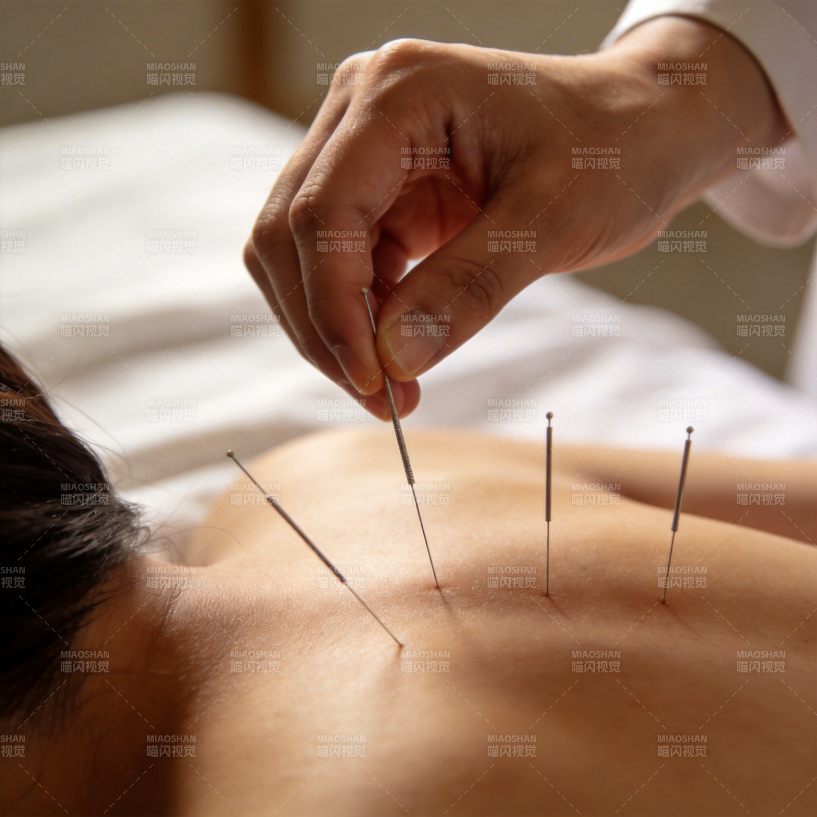 针灸疗法 背部施针调理图片