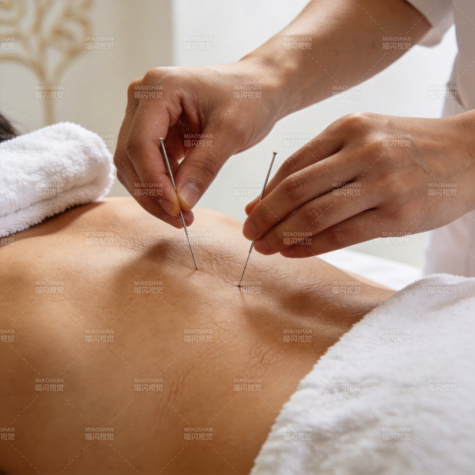 针灸疗法 背部精准施针图片