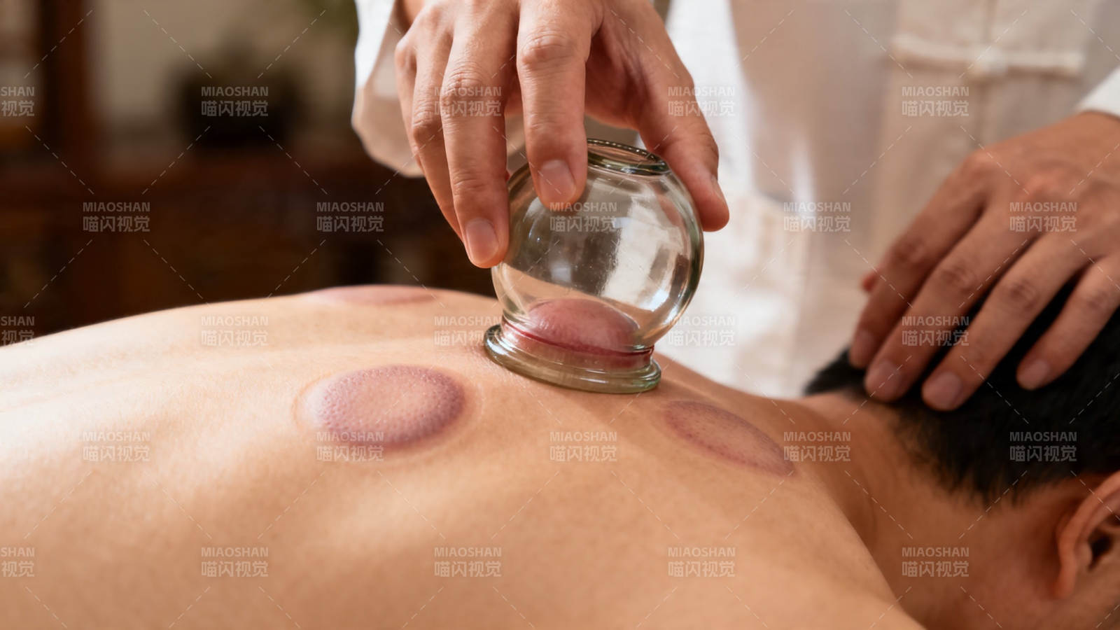 拔罐疗法 舒缓背部经络图片